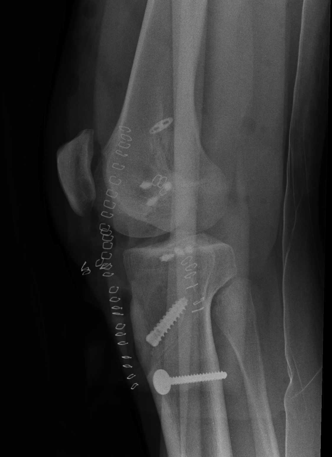 Knee Dislocation ACL PCL LCL Reconstruction Lateral